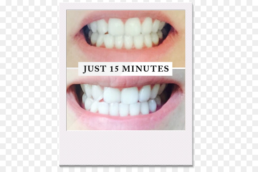ฟัน Whitening，มนุษย์ฟัน PNG