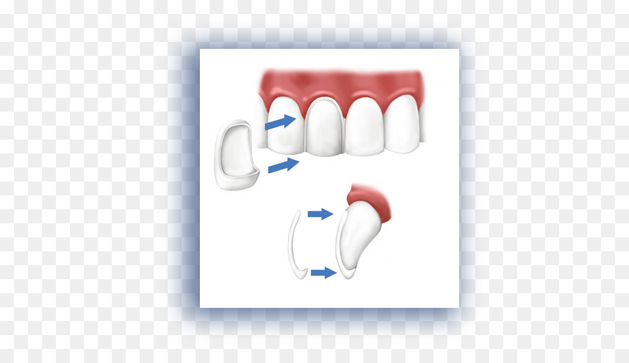 วีเนียร์ทันตกรรม，ฟัน PNG