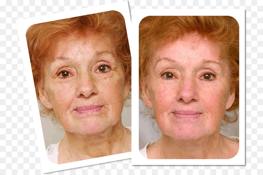 ริ้ว รอย，Antiaging ศกรีม PNG