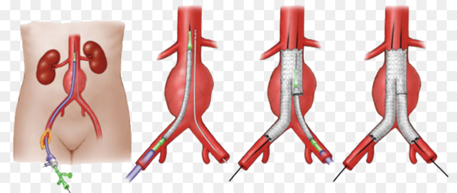 ในช่องท้อง Aortic เส้นเลือดโป่งพอง, Endovascular ของหลอดเลือดโป่งพอซ่อม ...