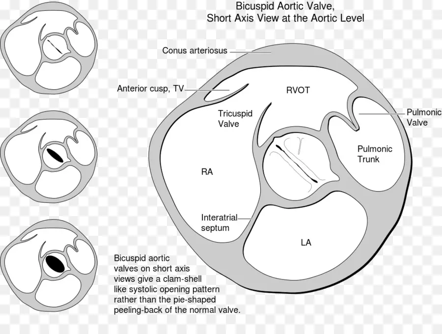 วาล์วเอออร์ติค Bicuspid，หัวใจ PNG