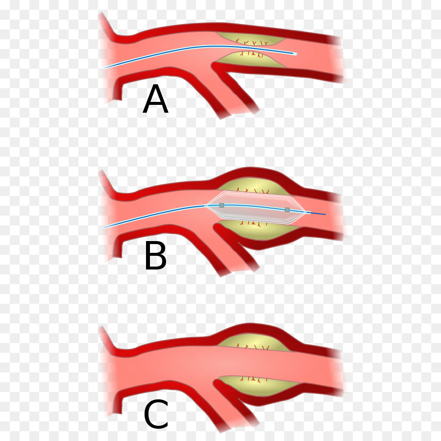 การขยายหลอดเลือด，ขั้นตอน PNG
