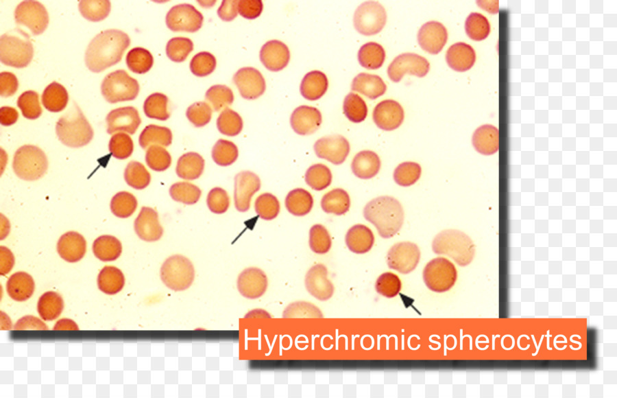 โรคโลหิตจาง Hemolytic，จาง PNG