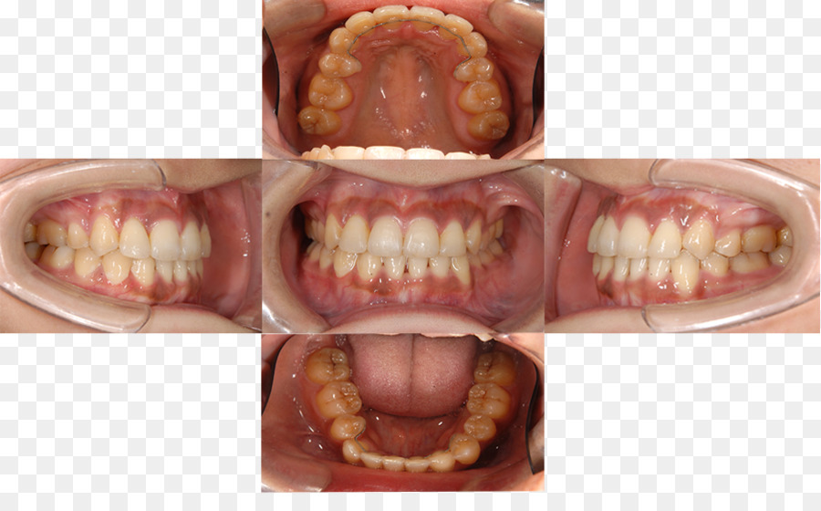 ฟัน，Periodontal โรค PNG