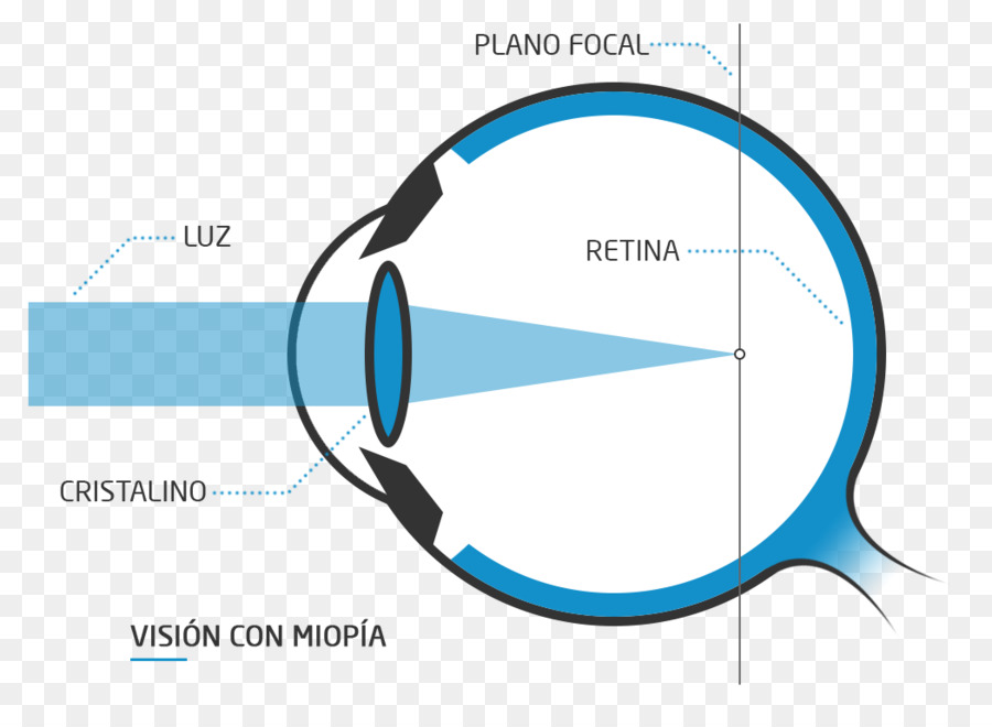 Myopia Diagram，ดวงตา PNG