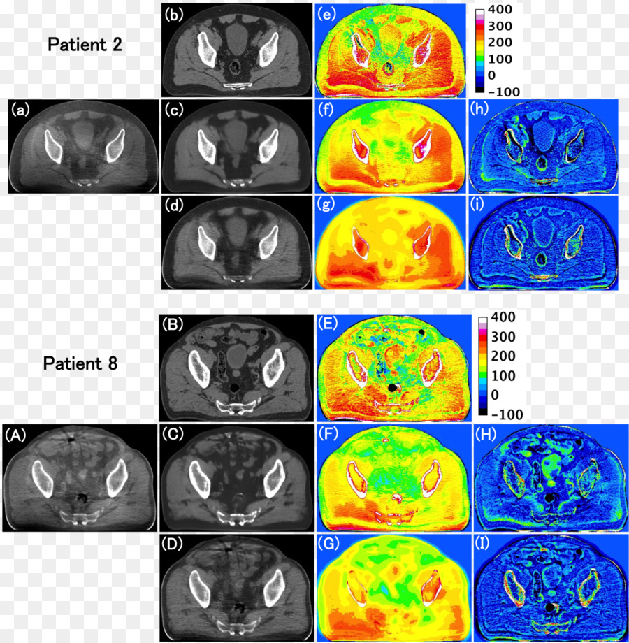 การถ่ายภาพทางการแพทย์，โคบีมส่วนที่คำนวณแล้ว Tomography PNG