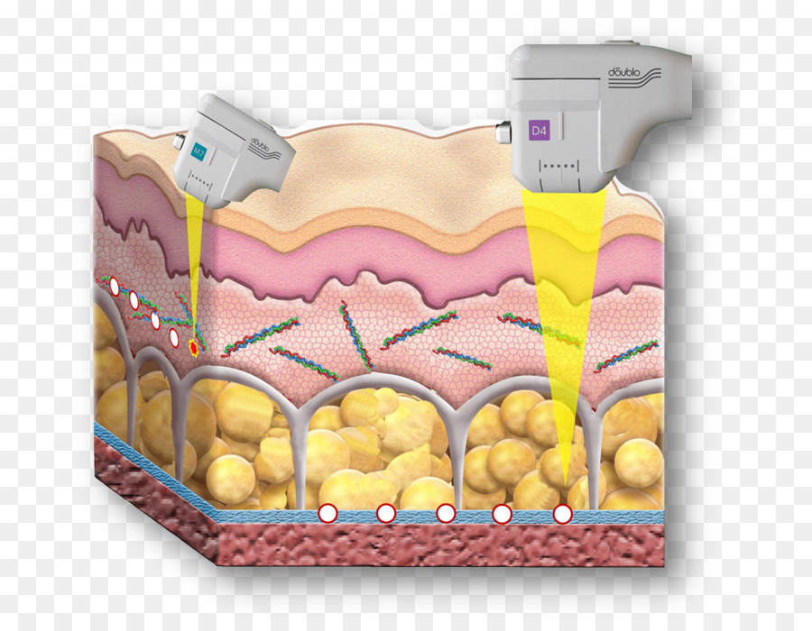 Rhytidectomy，อัล ตร้า ซาวด์ PNG