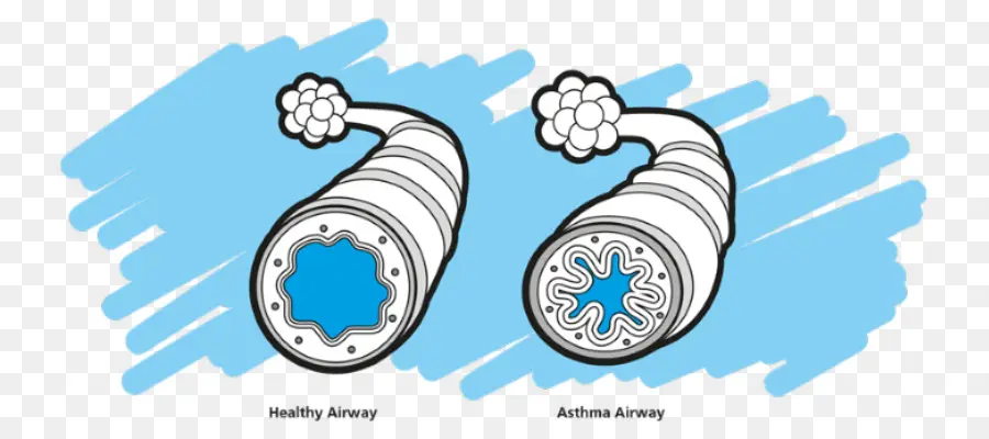 Asthma Airway，สุขภาพดี PNG