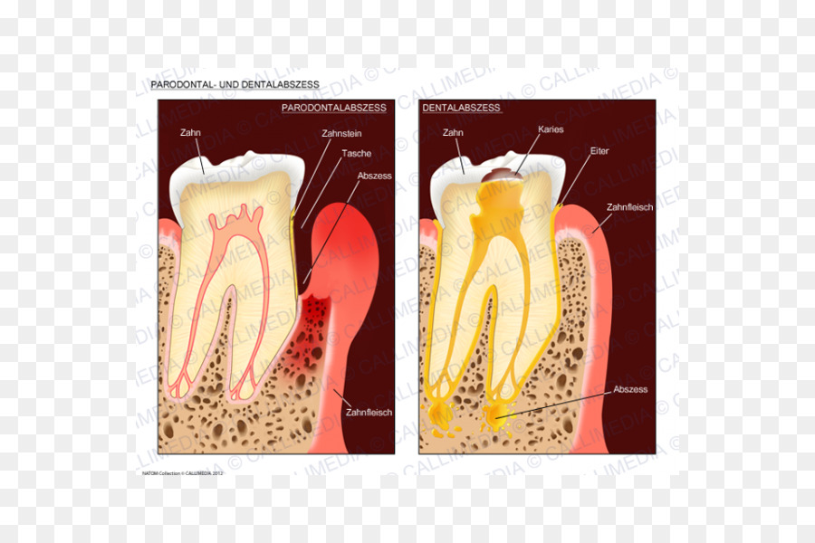 ทำฟันก้อนหนอ，ก้อนหนอ PNG