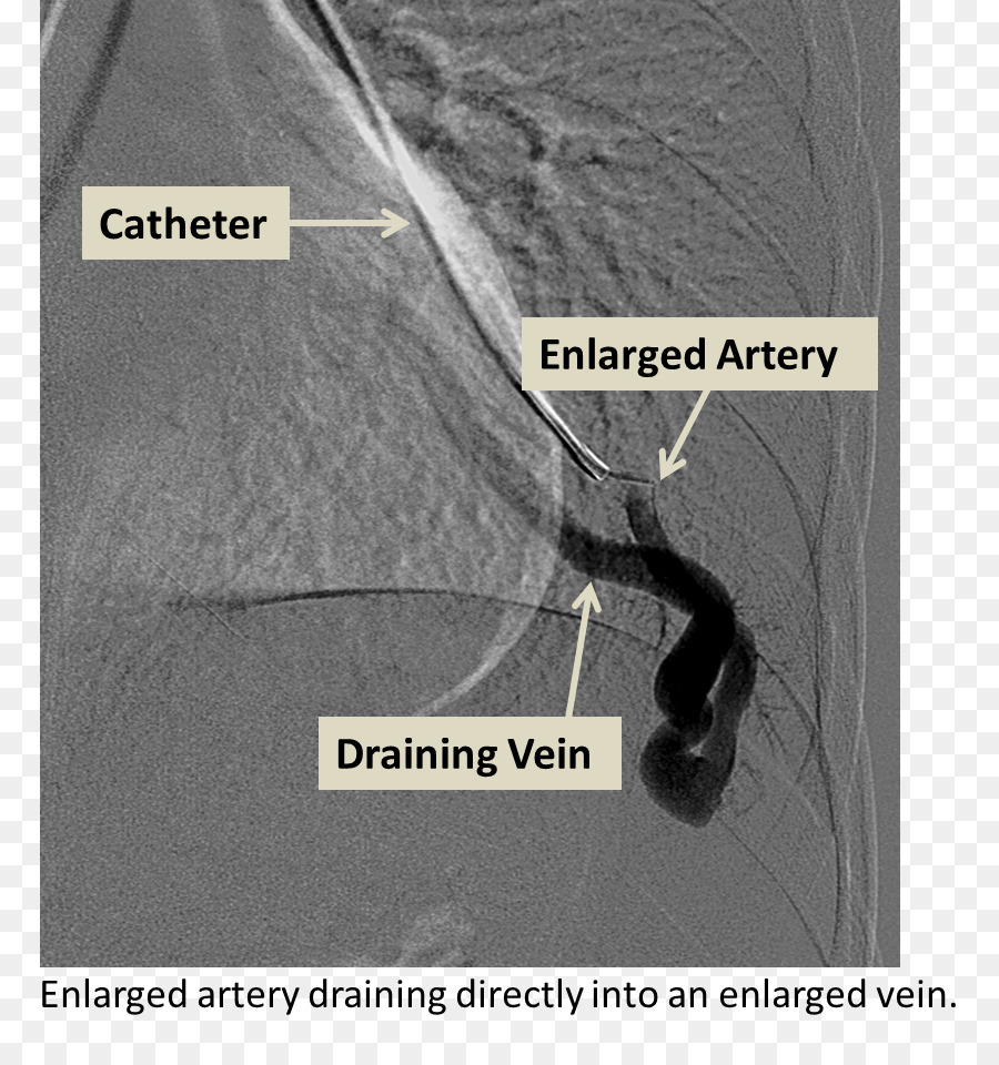 Arteriovenous Malformation，ปอด PNG