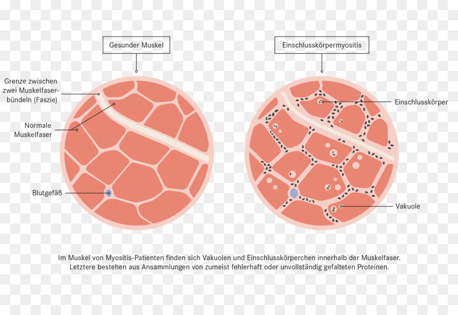 Inclusion ศพ Myositis，การบำบัด PNG