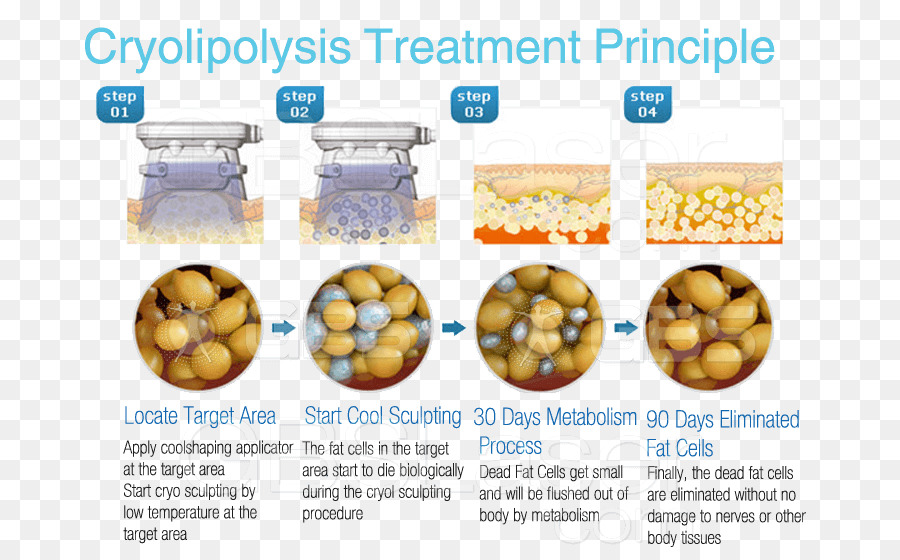 การรักษาด้วย Cryolipolysis，การลดไขมัน PNG