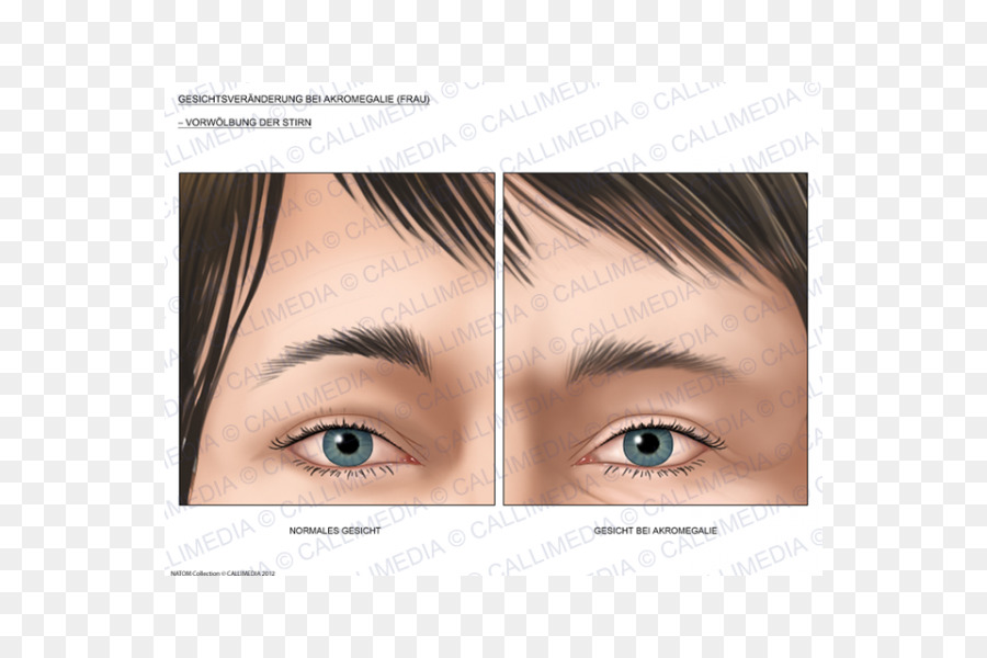 หน้า Acromegaly，ใบหน้าปกติ PNG