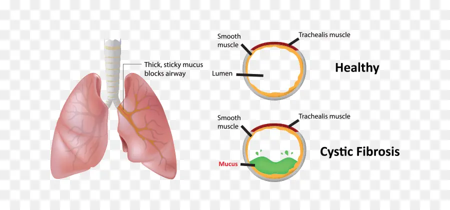 ไดอะแกรม Cystic Fibrosis，ปอด PNG