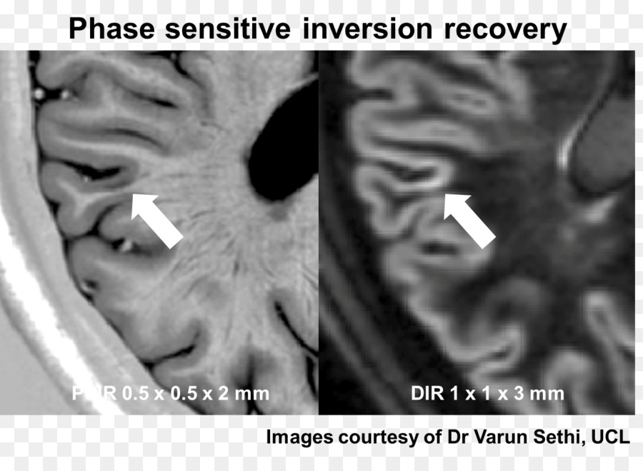 หลาย Sclerosis，แม่เหล็ก Resonance การถ่ายภาพ PNG