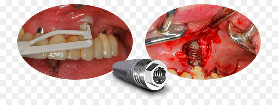 Automotive หาเบรกรถไฟ，Periimplantitis PNG