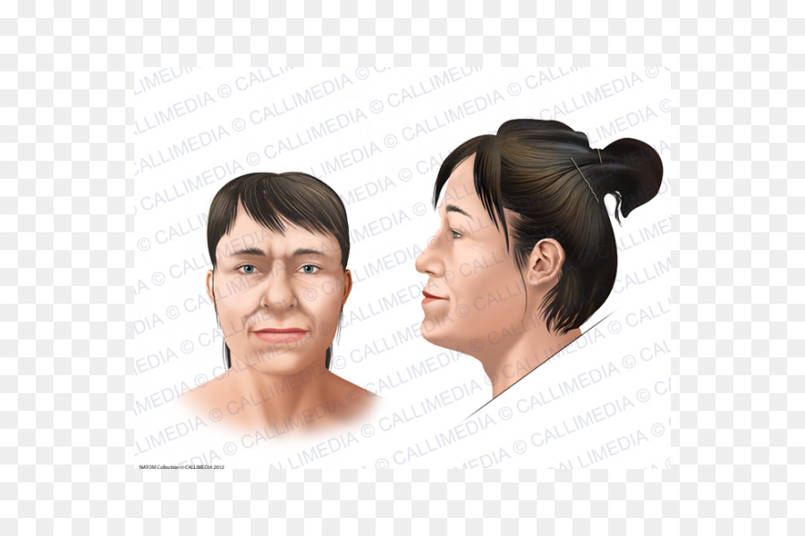 Acromegaly，หน้า PNG